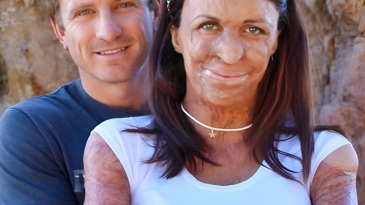Dvě stě operací, které vrátily život. Úžasný příběh australské modelky, která se stala obětí požáru