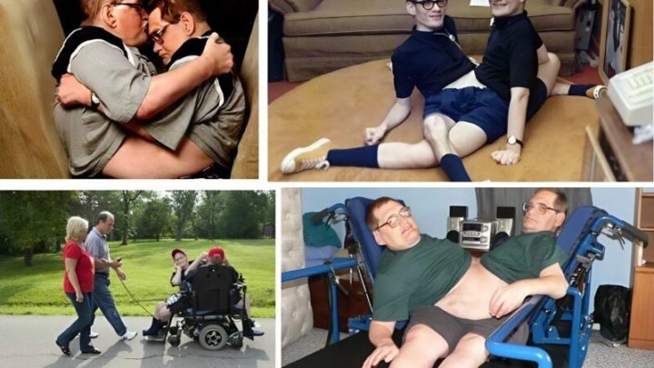 Tito dvojčata se narodila srostlá v oblasti břicha a pánve 😲