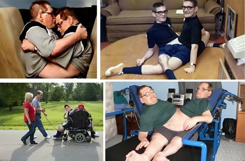 Tito dvojčata se narodila srostlá v oblasti břicha a pánve 😲