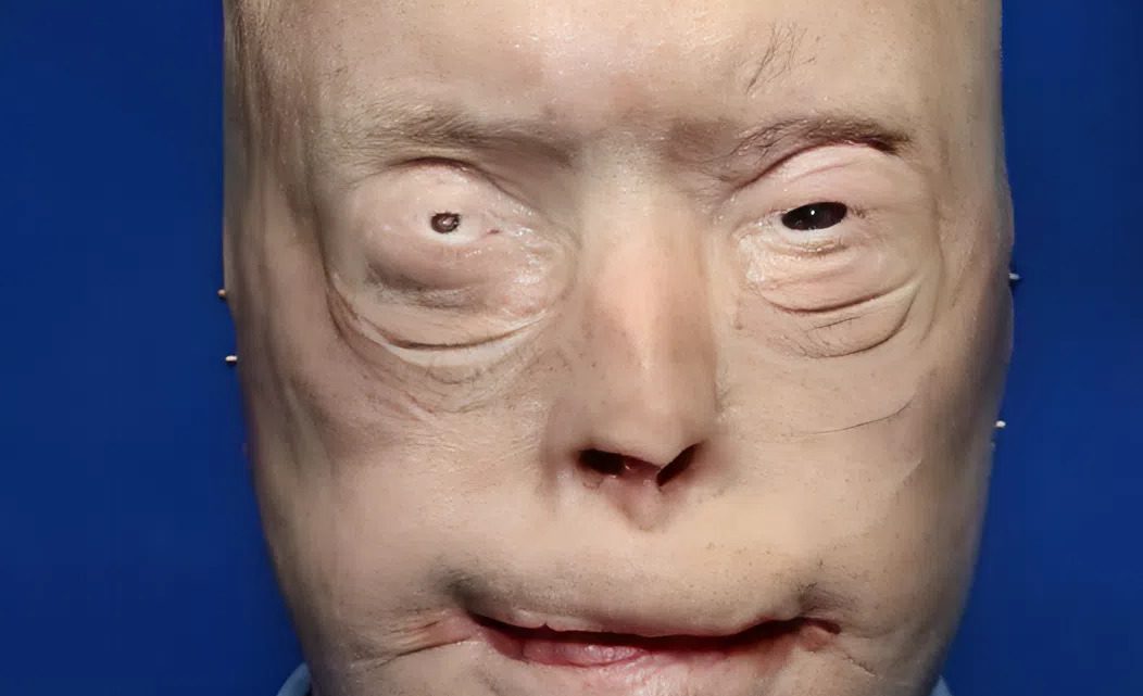 Hasič utrpěl popáleniny třetího stupně – takto vypadá o 7 let později