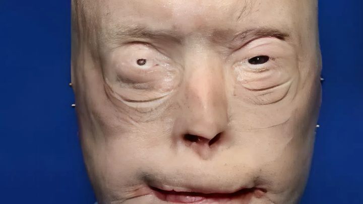 Hasič utrpěl popáleniny třetího stupně – takto vypadá o 7 let později