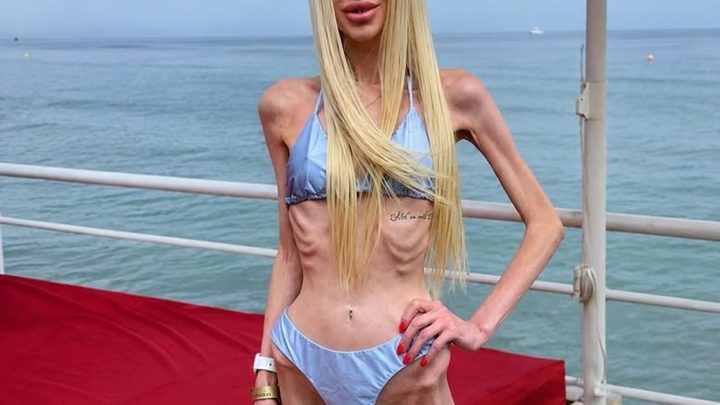 Slzy se derou do očí: Ukrajinka vážící 23 kilogramů ukázala, jak vypadala před dramatickým úbytkem váhy